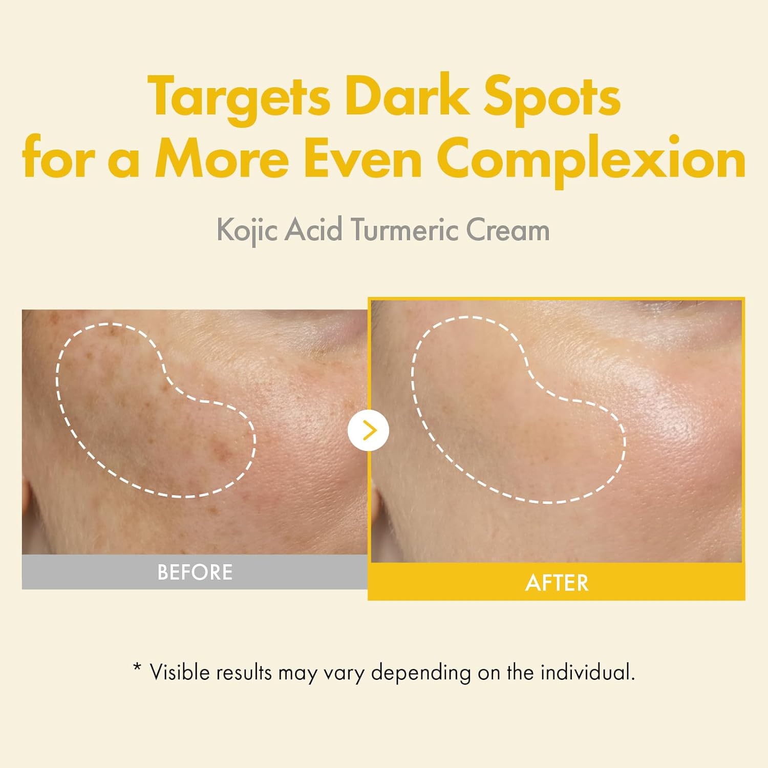 TOSOWOONG Kojic Acid Turmeric Cream, 99% Purity Kojic Acid 7,000ppm, 660,941ppm Turmeric, Dark Spot Corrector Capsule for Hyperpigmentation & Even Skin Tone Care, Korean Skincare, 50ml / 1.69 fl. oz.